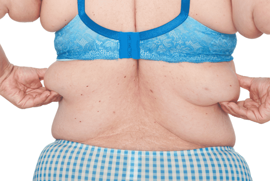 Types of back liposuction