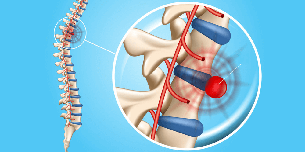 Mesmo após cirurgia, a hérnia de disco pode voltar? - Clínica da Coluna |  Dr. Fernando Schmidt e Dr. Sandro de Medeiros