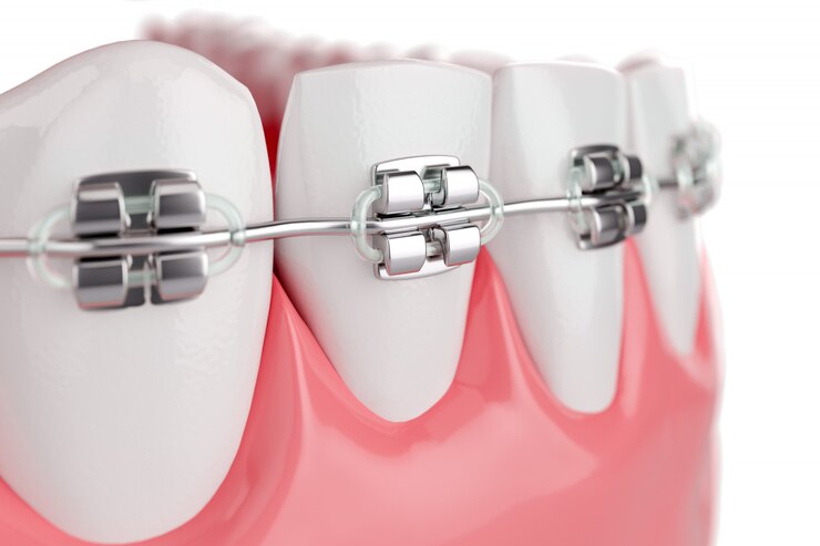 metal braces
metal braces cost singapore
metal braces singapore
cheapest metal braces in singapore