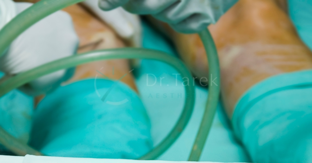 Awake Liposuction And Fat Transfer 5 Dr. Tarek Aesthetics | Best Plastic Surgeon In Dubai Awake Liposuction And Fat Transfer