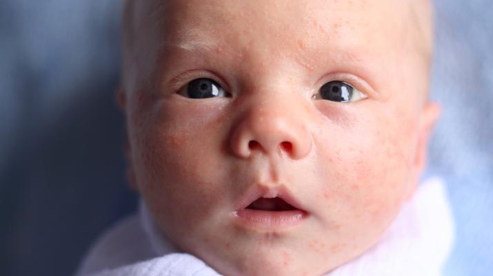 Ba mẹ nên lựa chọn sản phẩm phù hợp với làn da mỏng manh của bé