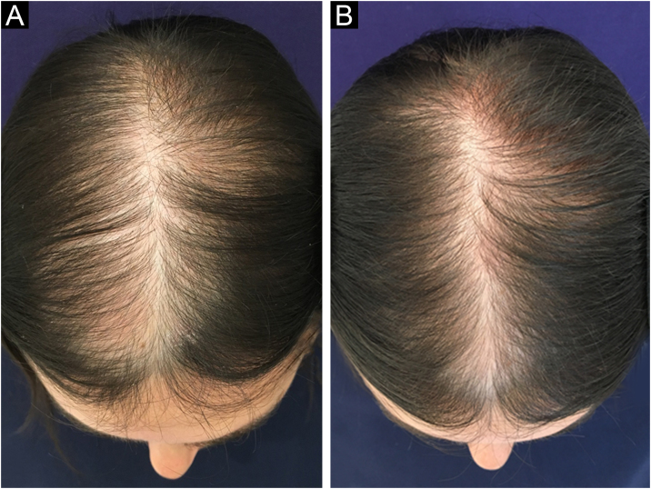 Female androgenic alopecia before and after treatment