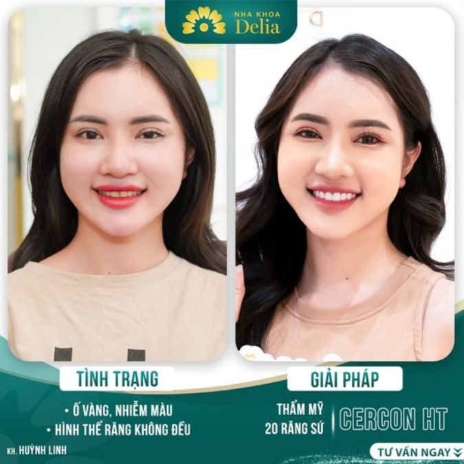 Cấu tạo của răng sứ Cercon HT