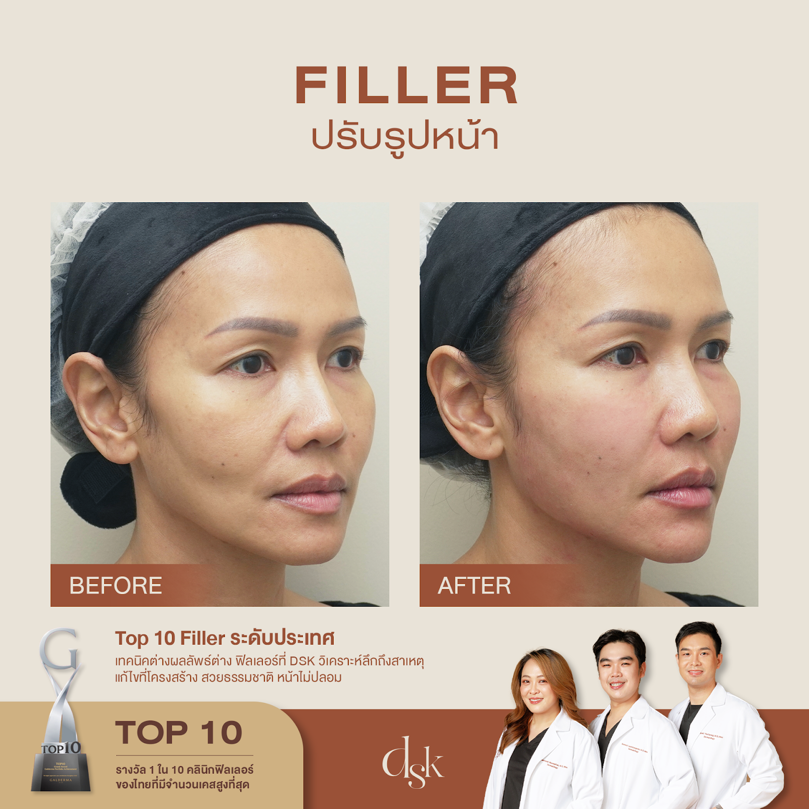 รีวิวฟิลเลอร์แก้มตอบที่ DSK Clinic