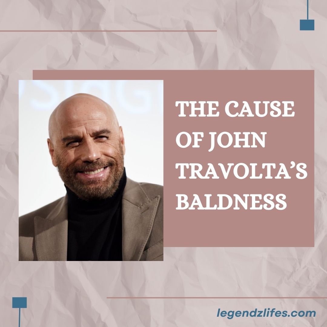 The Cause of John Travolta’s Baldness
