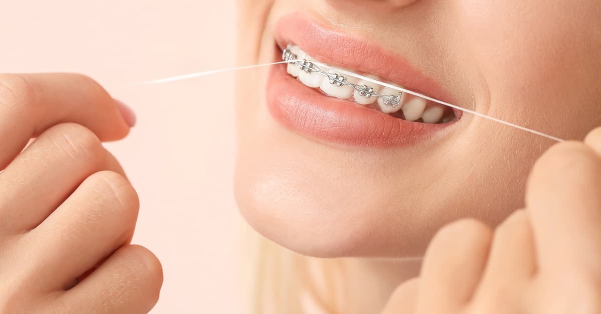 Why is Flossing Important with Braces