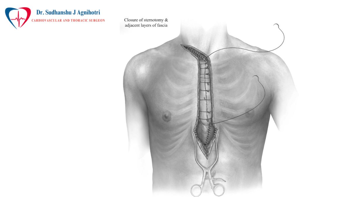 Reoperative Heart Surgery - Dr Sudhanshu J Agnihotri abest Cardiacty Specialist Near Me