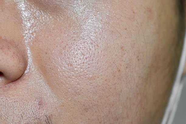 Close-up of a person’s cheek with oily skin, visible pores, and shine, common in acne-prone or sebum-rich skin types.