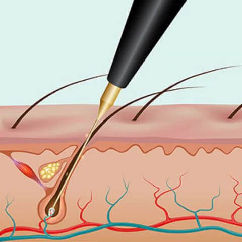 Illustratiion that shows an electrolysis probe in the hair follicle destroying the papilla during an electrolysis session