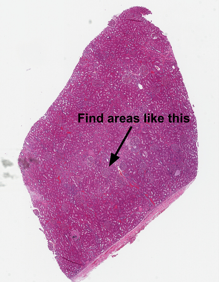 Renal tissue from the TCGA with an arrow pointing to a glomerulus and text reading "Find areas like this"