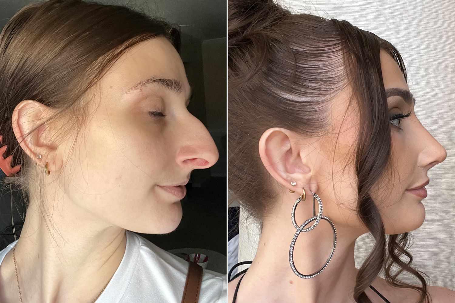Woman Shocked by How $11K Nose Job Changed Her Life (Exclusive)