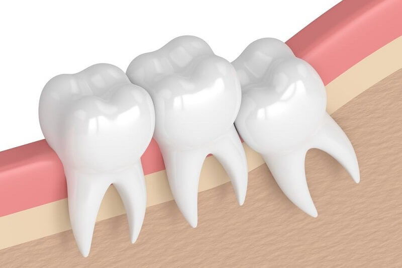 6 lý do phải nhổ răng khôn càng sớm càng tốt