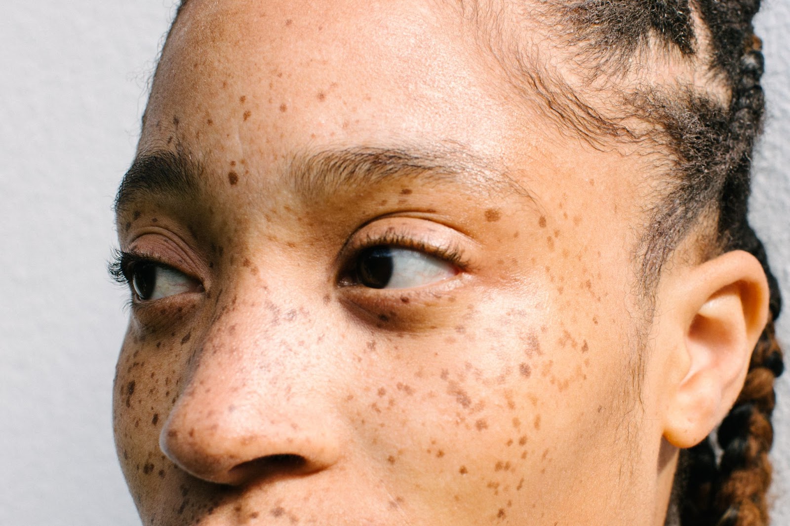 woman freckle skin