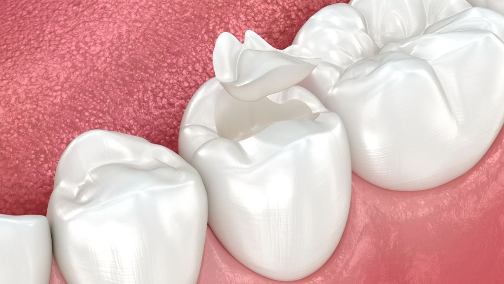 Additional Benefits of Ceramic Restorations