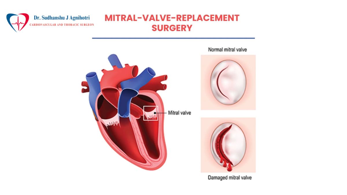 Heart Repair Surgeries - Dr Sudhanshu J Agnihotri - Best Cardiac Surgeon in Indore (3)