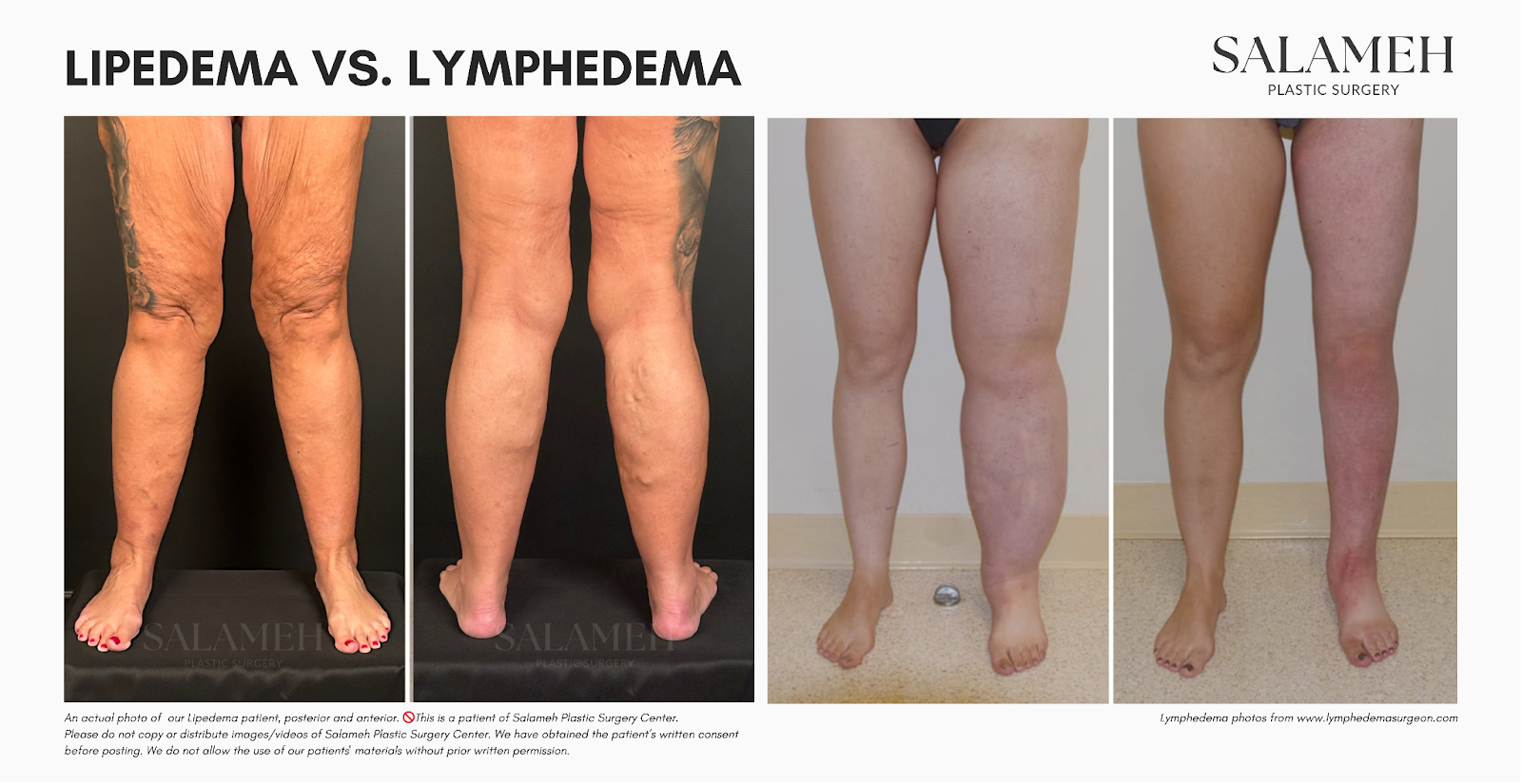 Photo showing the Differences Between Lipedema and Lymphedema using actual patients from Salameh plastic surgery center.