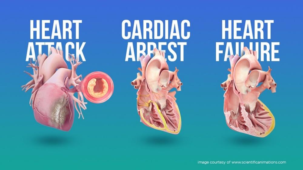 Apa Perbedaan Serangan Jantung, Henti Jantung, dan Gagal Jantung - Kurnia  Teknologi Indonesia