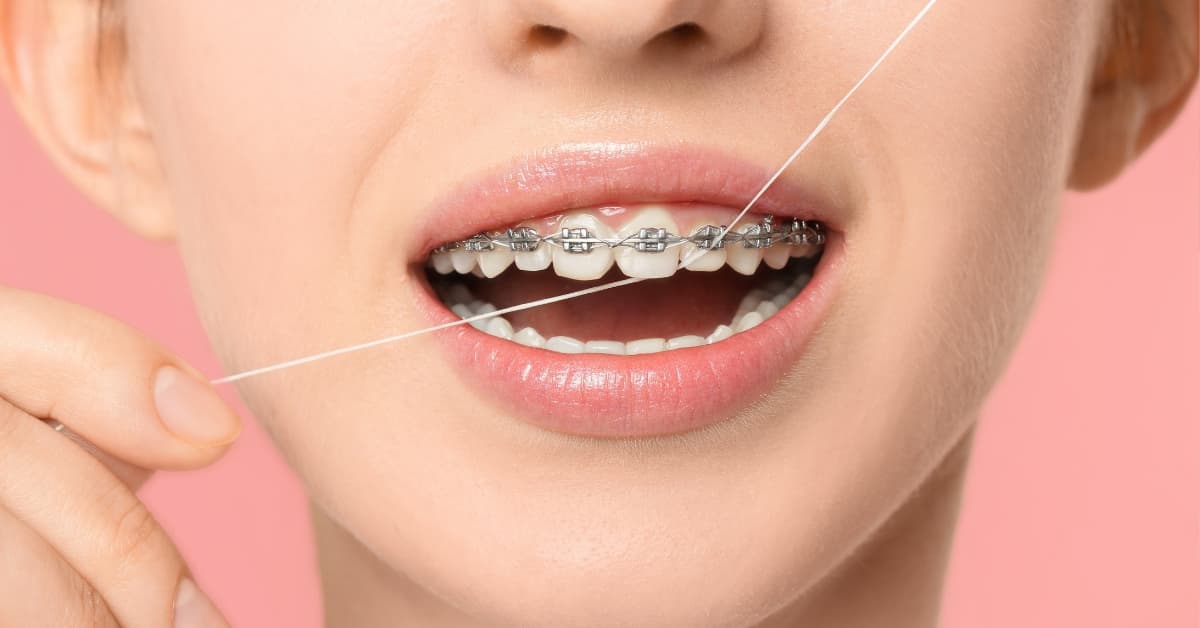 Benefits of Flossing Regularly with Braces