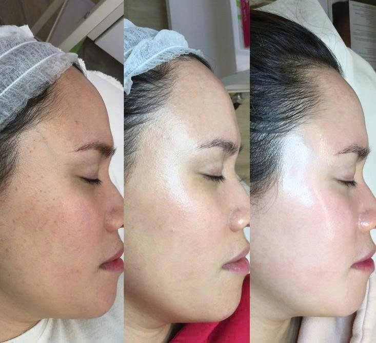Hiệu quả của công nghệ laser Fotona tại Canary Beauty