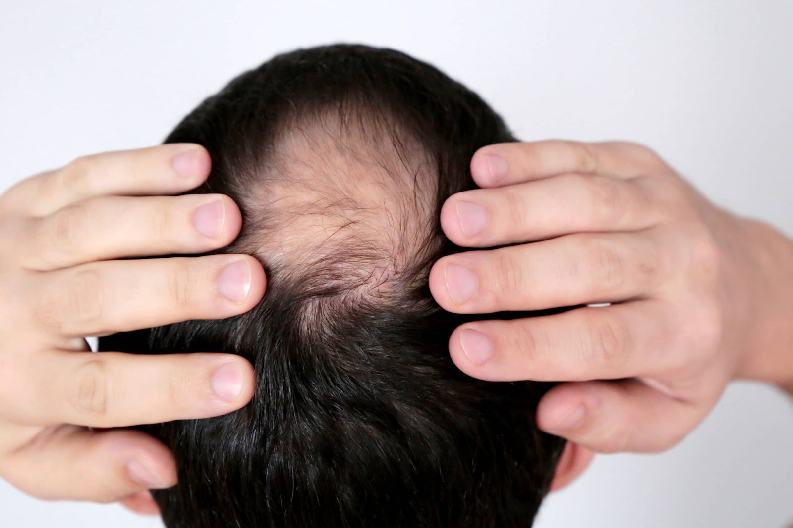 bald spot, bald patches, getting bald signs, know the difference between hair loss and hair shedding.