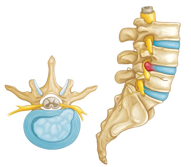 Hernia discal lumbar