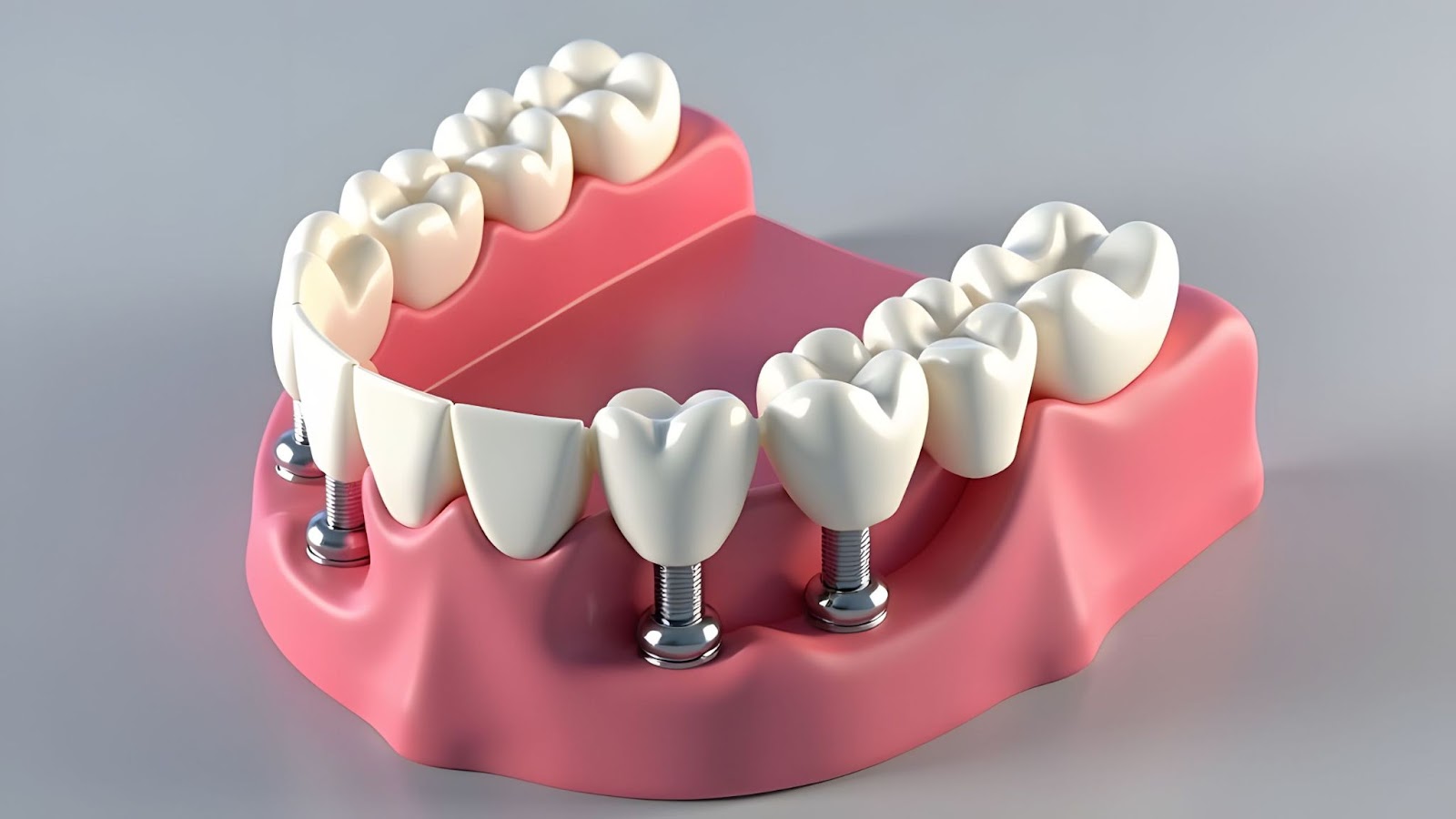 A Woman’s Guide To Different Types Of Dental Implants