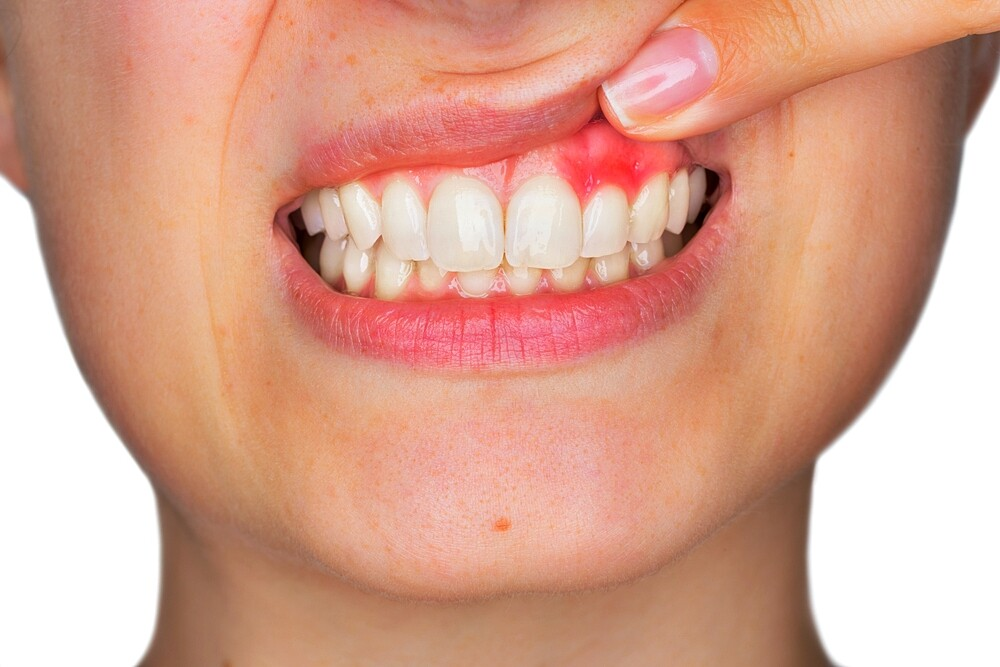  inflamed gums