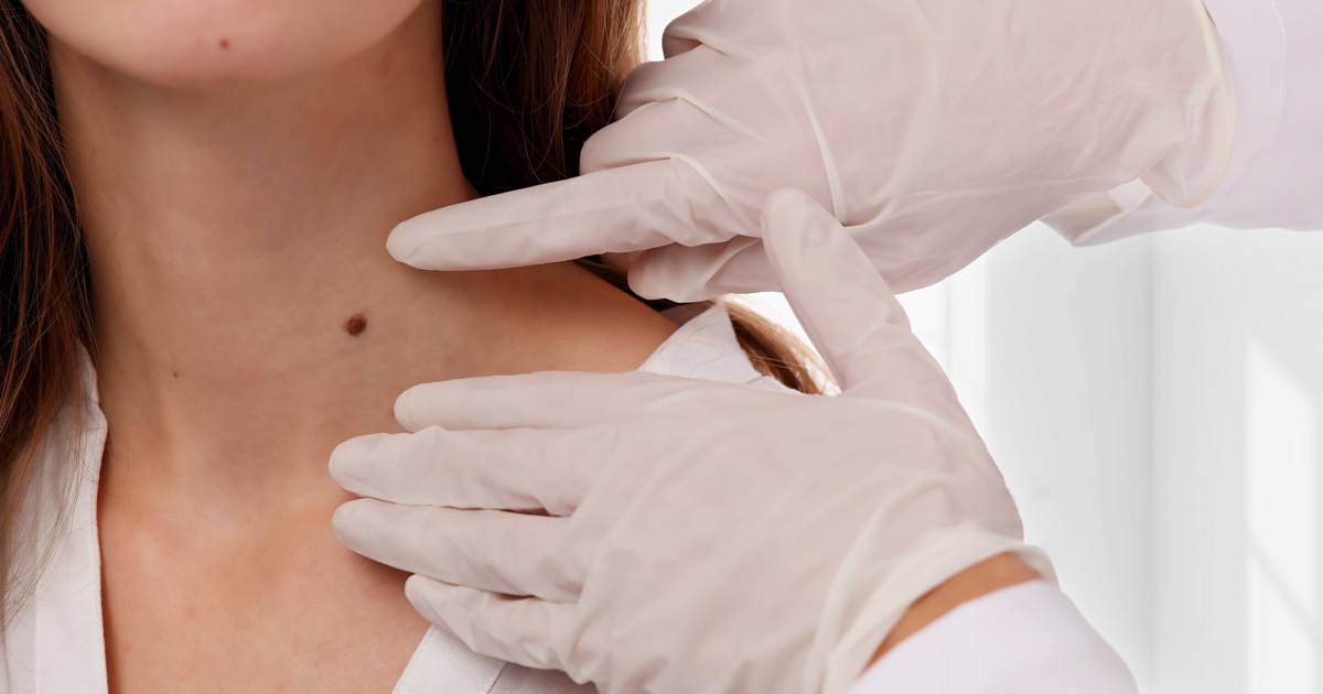 Removal of benign skin growth using laser