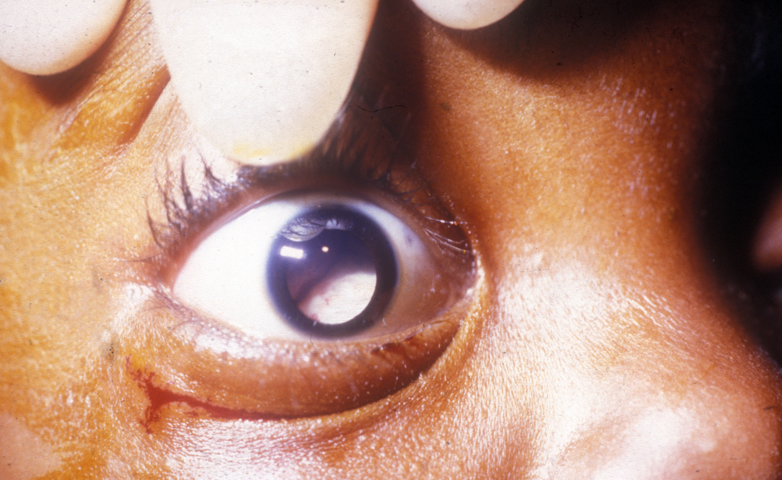 Pupillary white reflex or leukocoria
