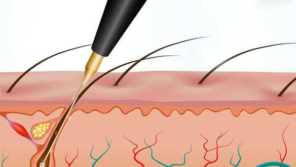 Điện phân sử dụng dòng điện để phá hủy nang lông, ngăn chặn lông mọc lại