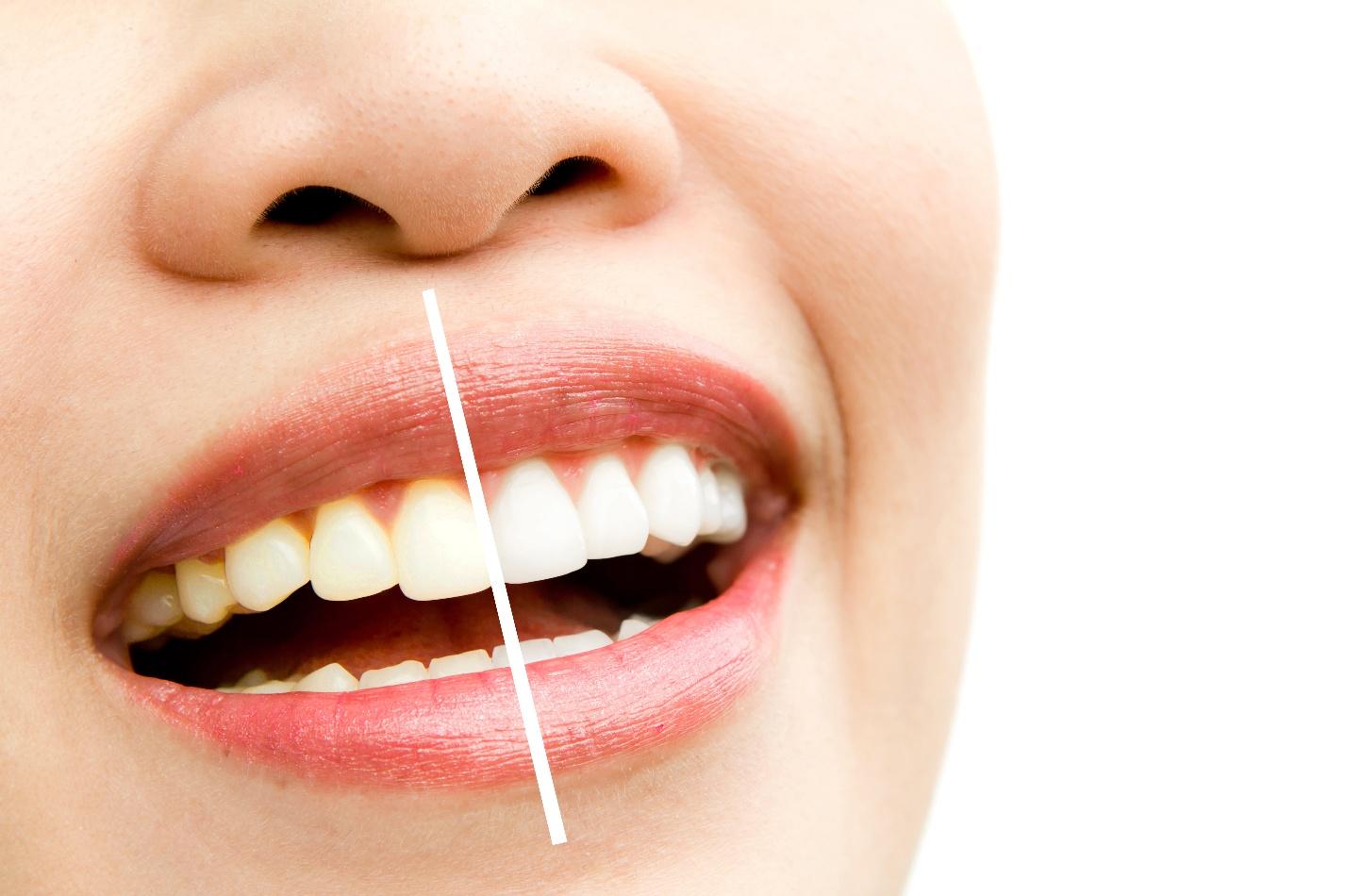 Close-up of a person's mouth with a white tooth

AI-generated content may be incorrect.