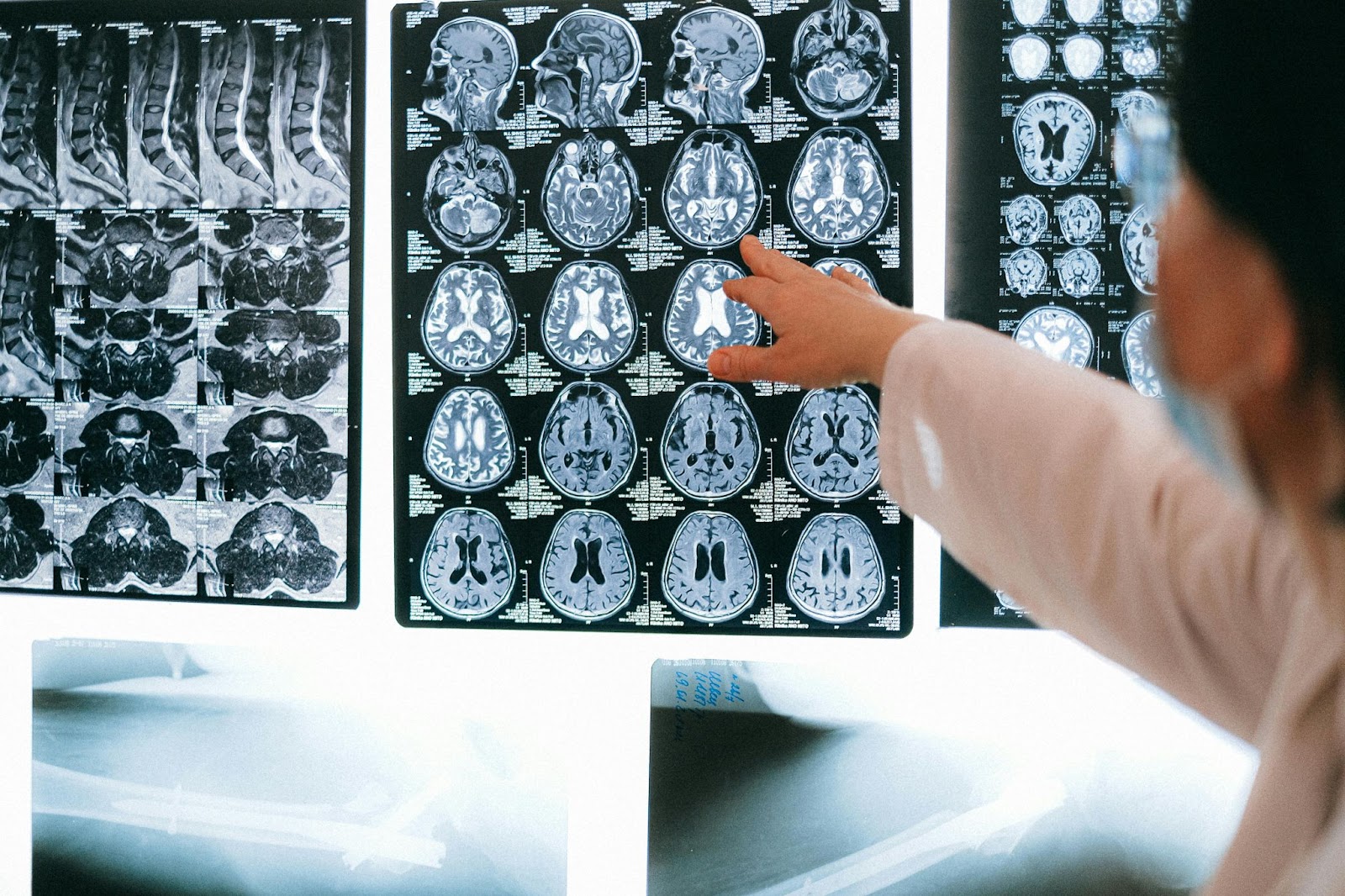médico apuntando a fotos de cerebros.