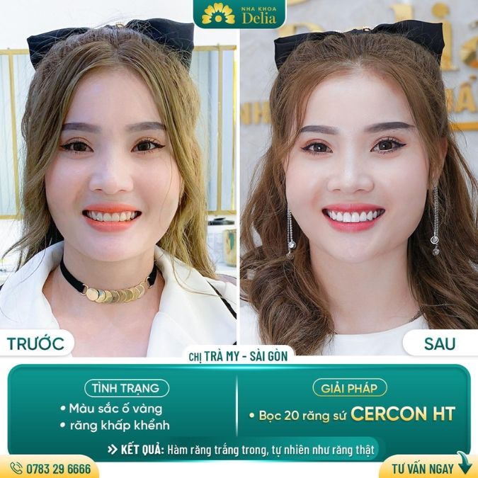 Răng sứ Cercon HT giá bao nhiêu?