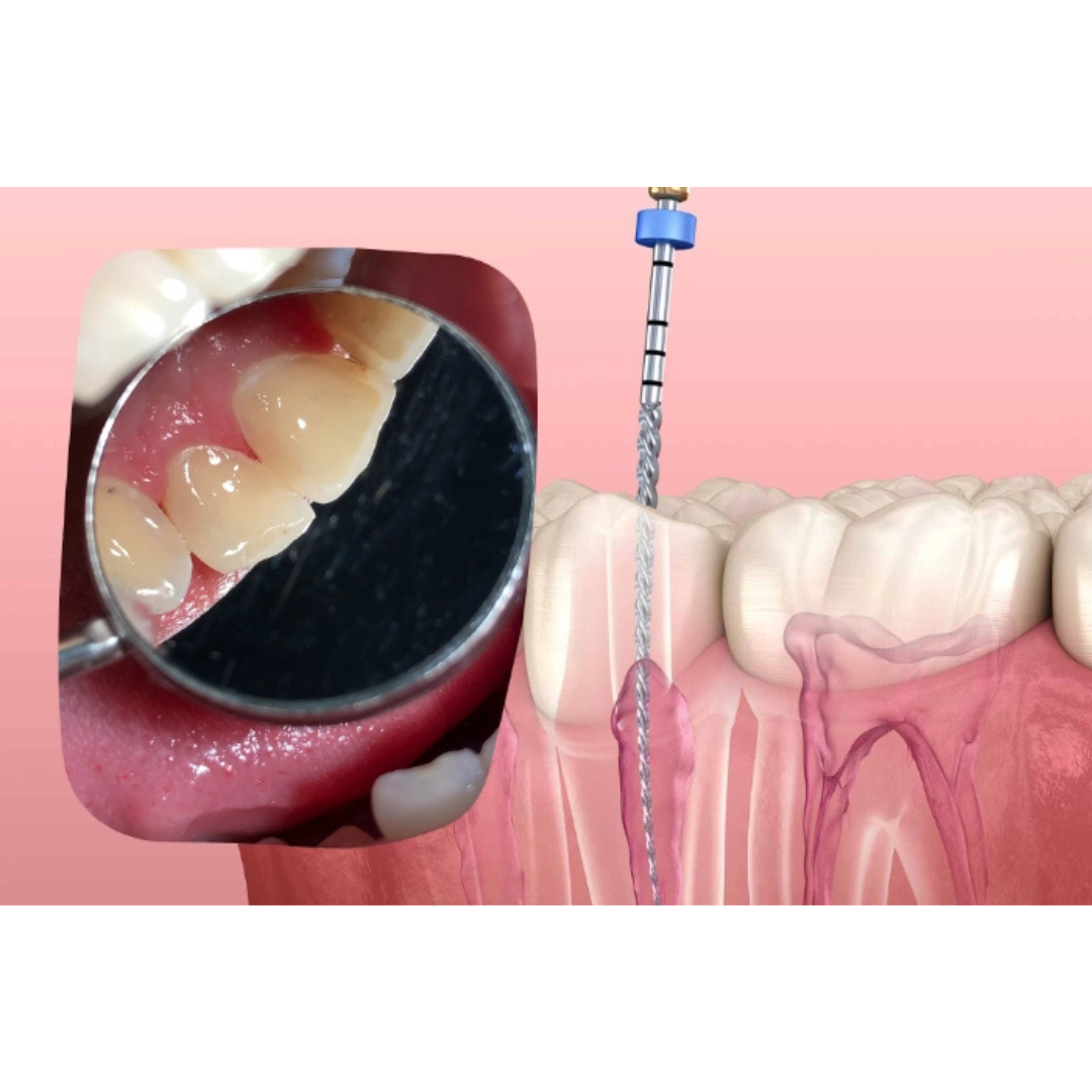 Incisor Root Canal: Ensuring a Healthy Smile