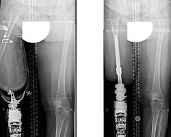 Image of Osseointegrated Limb Prosthesis