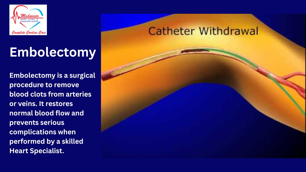 Embolectomy - Dr Rakesh Jain - Heart Specialist In Indore