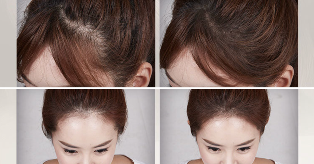 A series of four images showcasing the results of a hair loss treatment on a woman. The top two images show thinning hair at the crown and hairline before the treatment. The bottom two images show the same person after the treatment, with fuller hair and improved density in the areas that previously showed thinning.