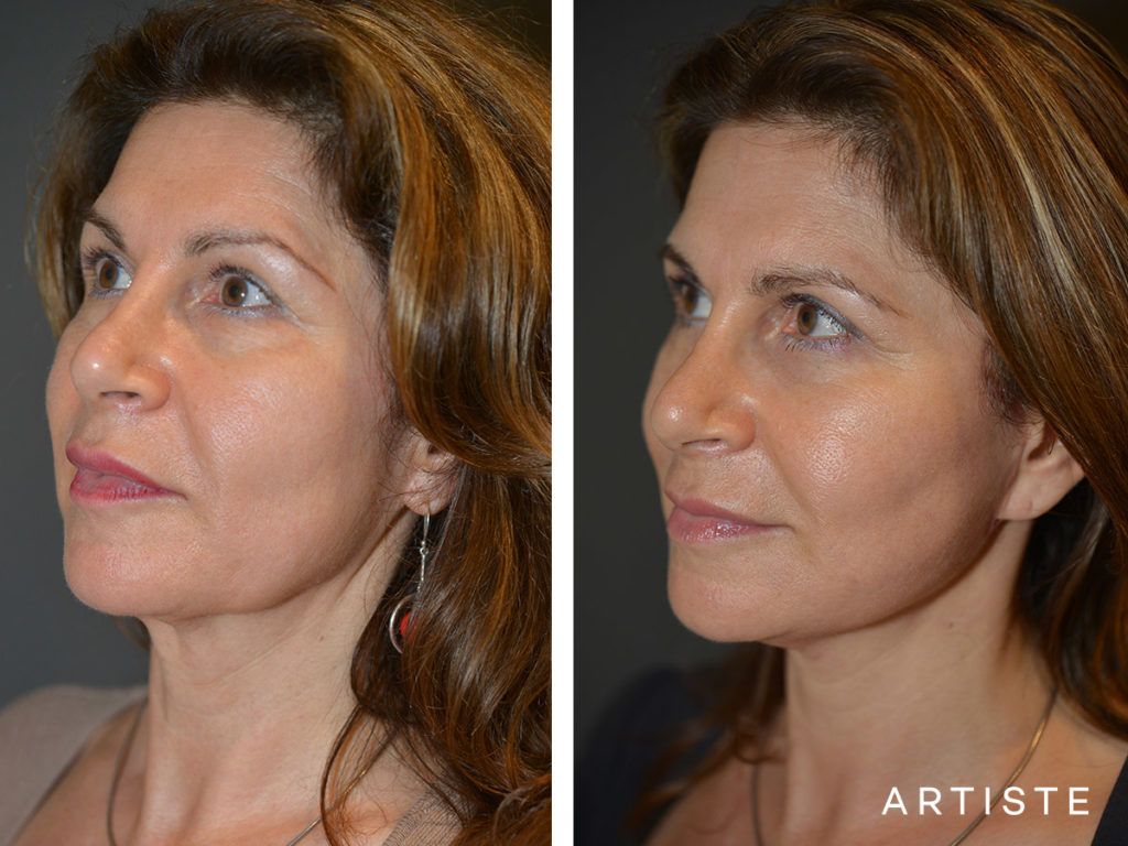 52 Year Old Signature Facelift + Fat Grafting