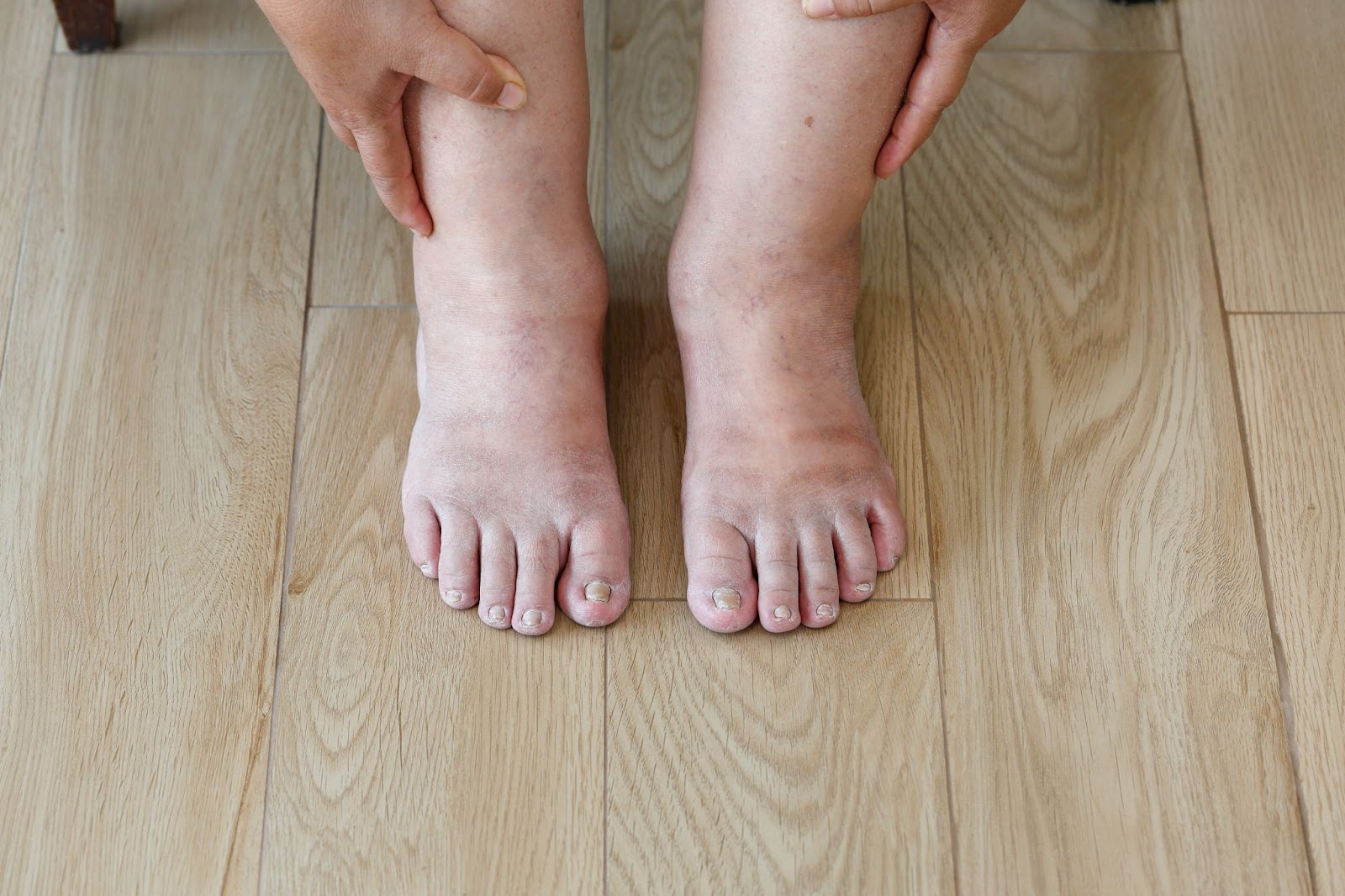 Diabetes Feet Symptoms and Its Treatment