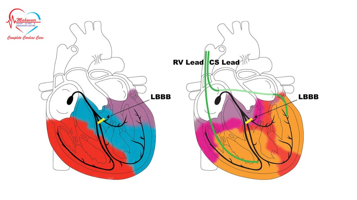 Cardiac Resynchronization Therapy performed by Dr Rakesh Jain a Top cardiologist in indore