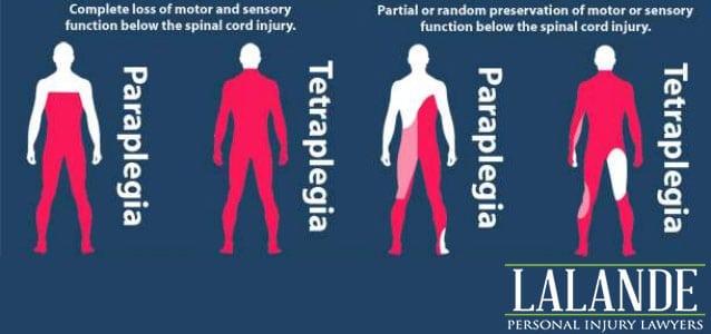 What’s the Difference Between Tetraplegia and Quadriplegia? - Lalande ...