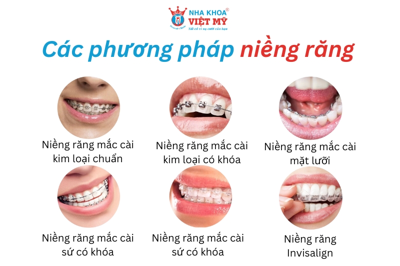 các phương pháp niềng răng khắc phục mặt lệch