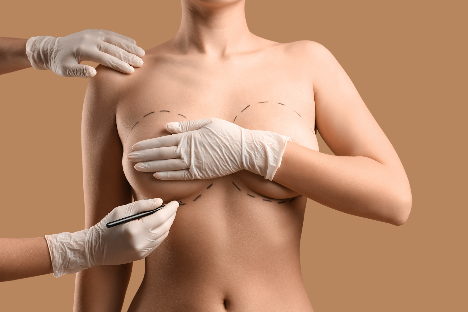 Plastic surgeon outlining breast for body fat transfer, showing natural enhancement approach.