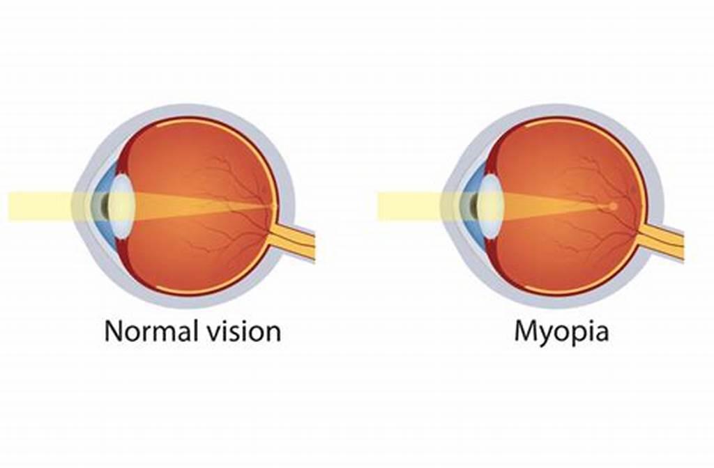 Myopia - Parkes Phoenix