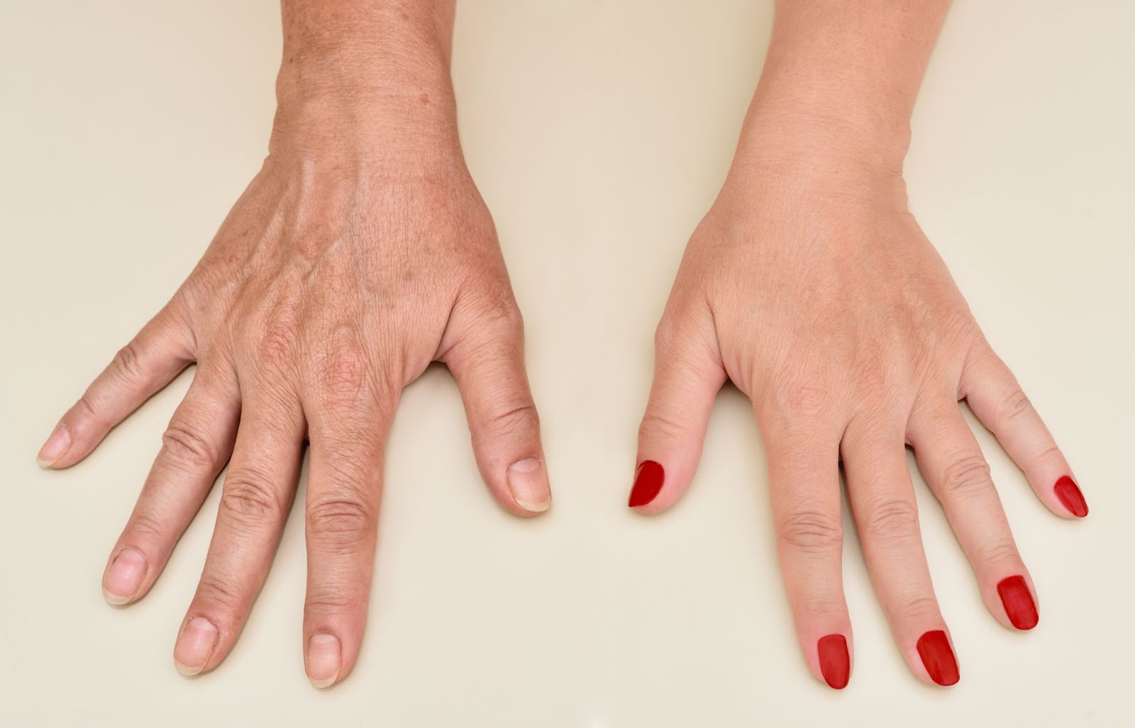 A woman's hands before and after hand rejuvenation. The right hand is more wrinkled with some pigmentation. The left hand is smoother and clearer with red manicured nails.