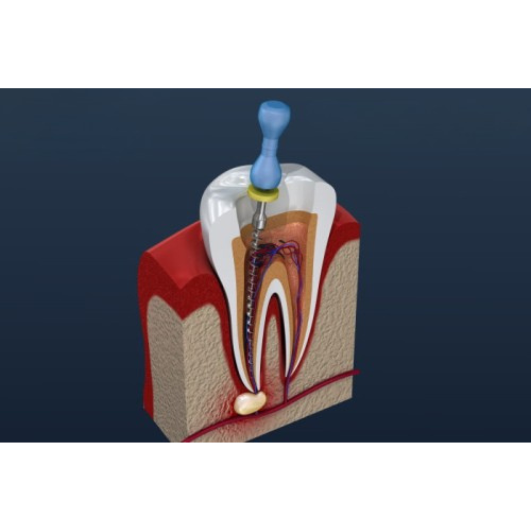 Types of Root Canals Boston Patients Commonly Need