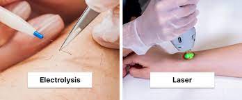 This contains an image of Electrolysis hair removal vs. Laser hair removal