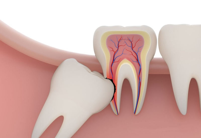 Nhổ răng số 8 có đau không? - Cách giảm đau hiệu quả