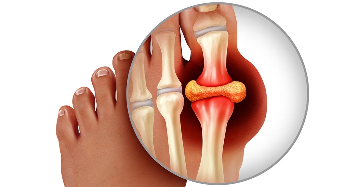 Gout – The Painful Crystal Buildup