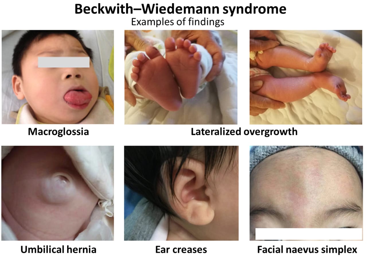 Common physical signs of Beckwith-Wiedemann syndrome